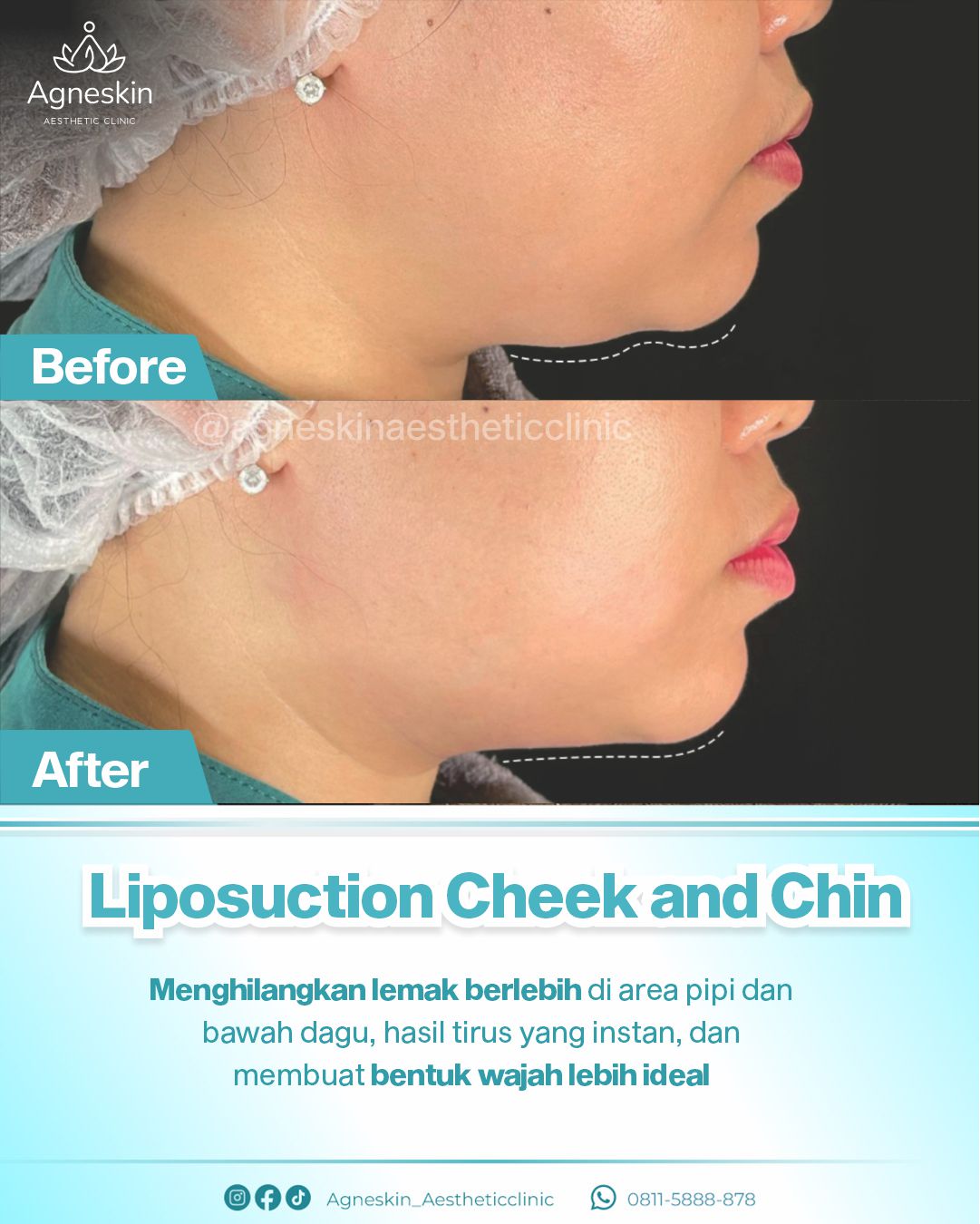 Before After Liposuction Cheek